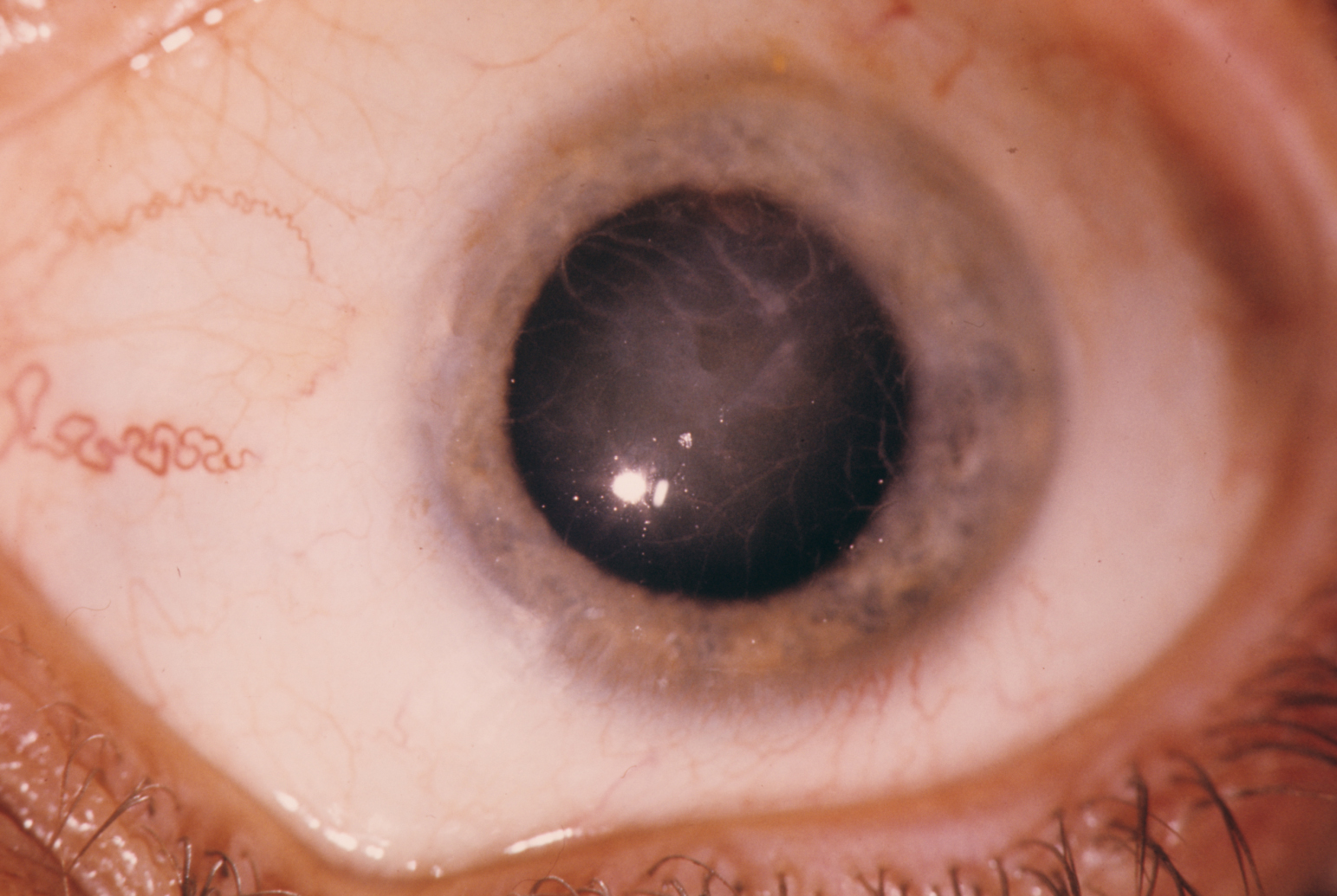 Corneal Dystrophy Lattice Type I Hereditary Ocular Diseases